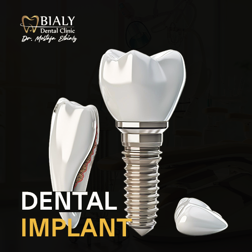 dental implants زراعة الأسنان